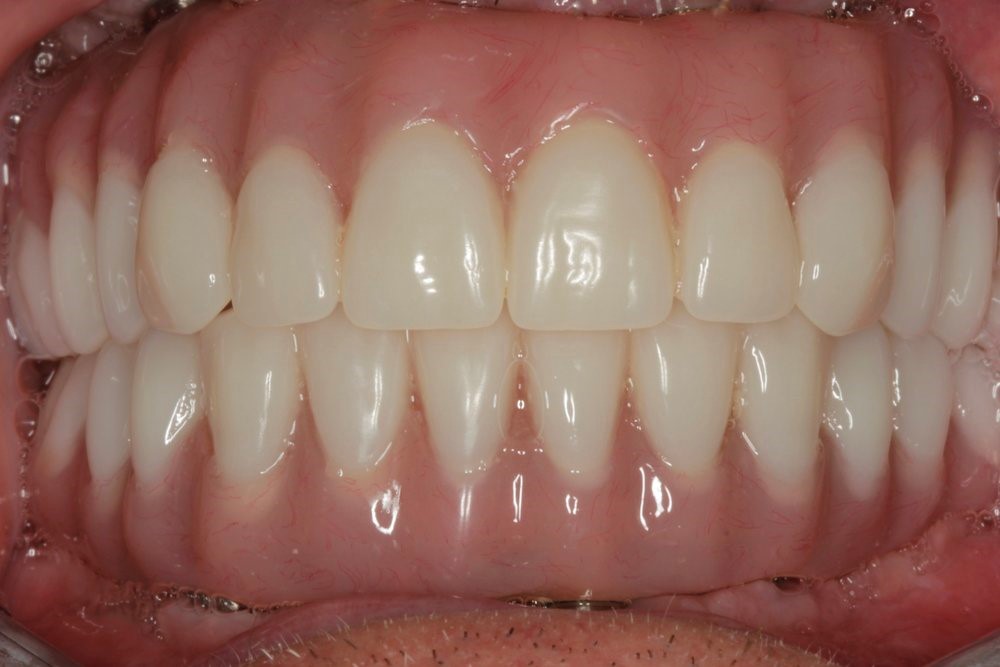 Braces With Partial Dentures Winnetka CA 91306